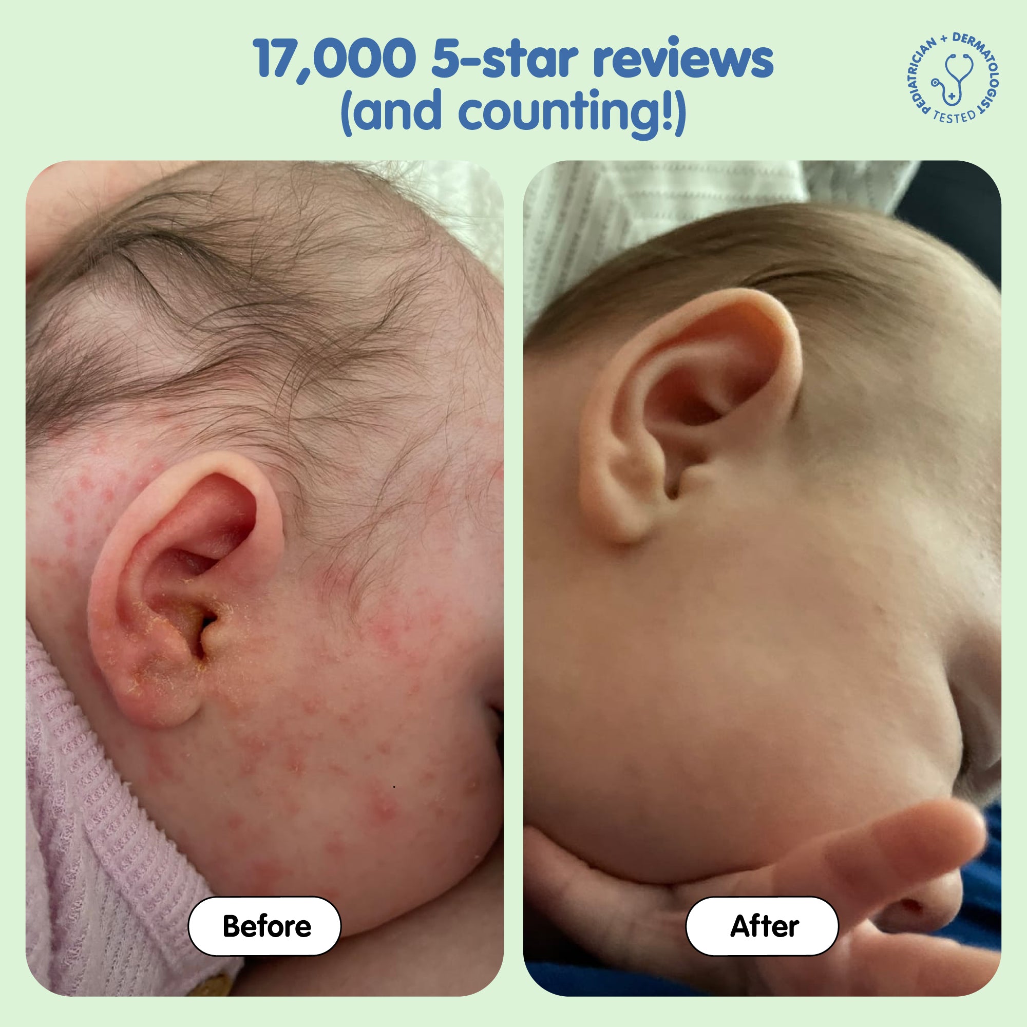 All Over Ointment Eczema Relief - Image 6